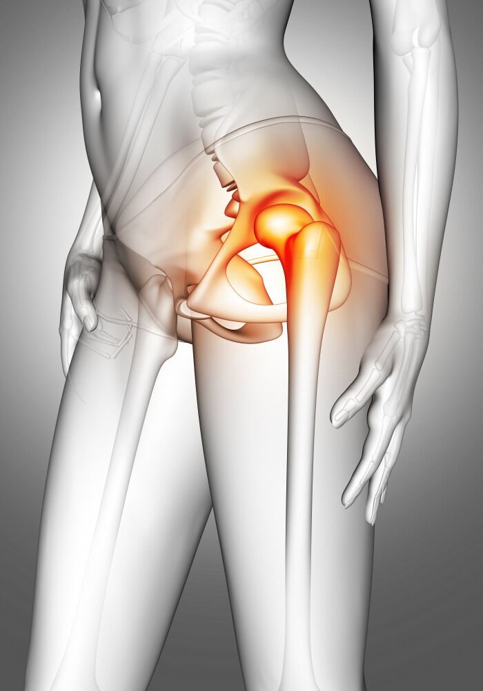 αρθροπλαστική ισχίου