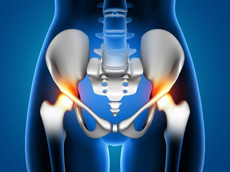 αρθροπλαστική ισχίου