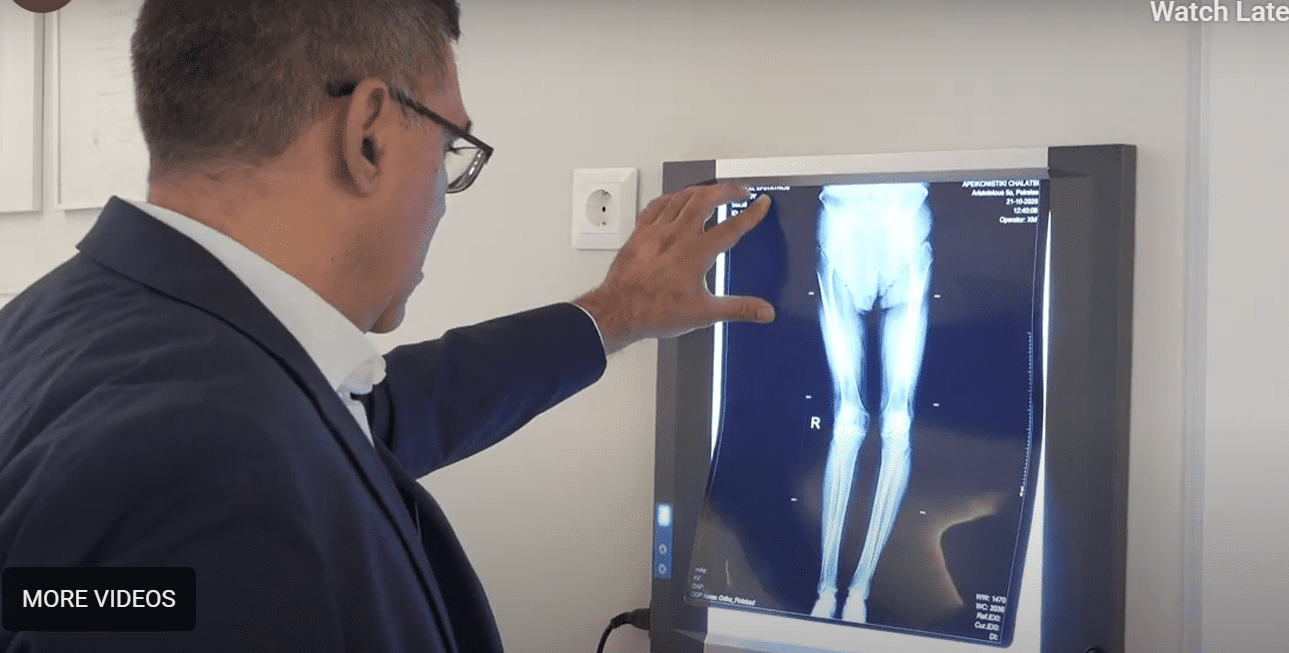 Πλεονεκτήματα Αρθροσπλαστικής ισχίου